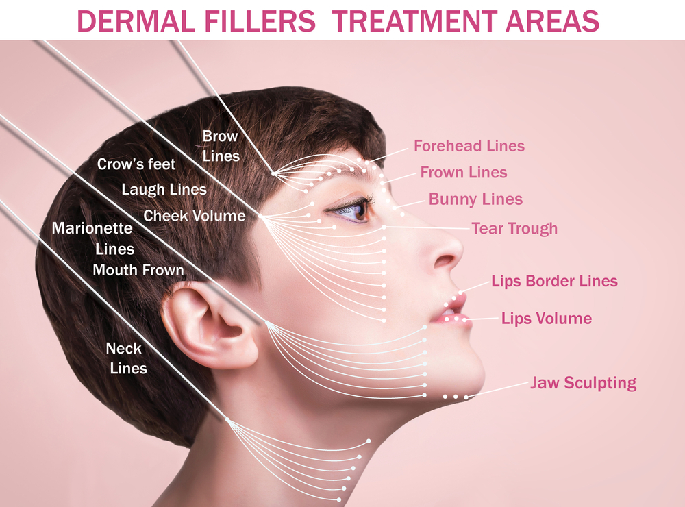 Diagram highlighting treatment areas for dermal fillers on the face and neck.